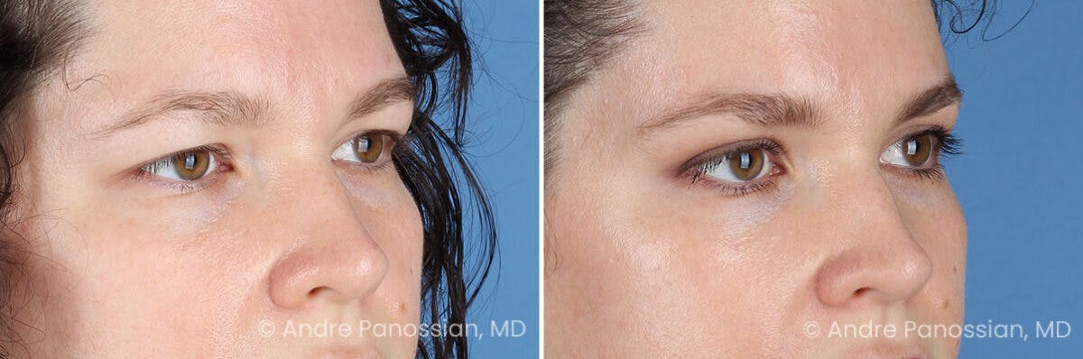 Eyelid Surgery (Blepharoplasty) Before & After Gallery - Patient 182379 - Image 2