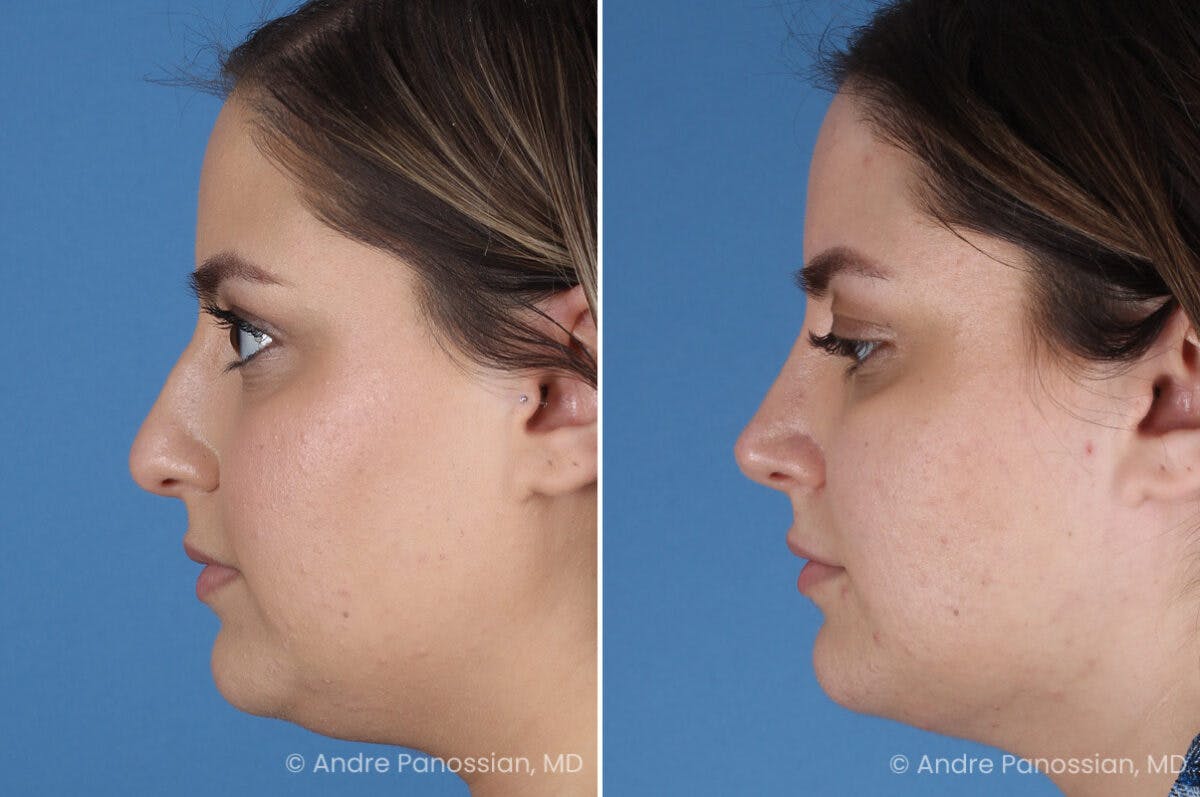 Rhinoplasty Before & After Gallery - Patient 153862 - Image 6