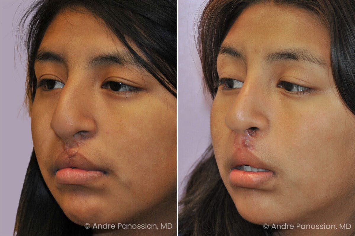 Cleft Lip Rhinoplasty Before & After Gallery - Patient 355708 - Image 3