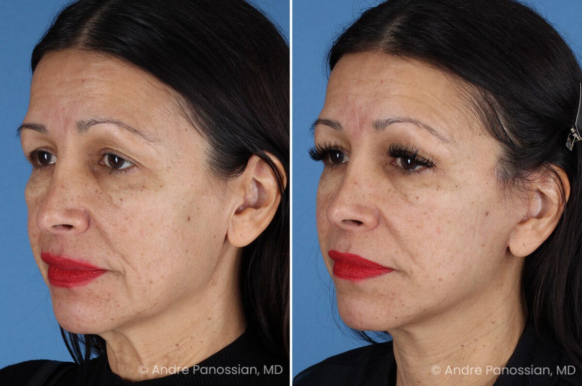 Facelift & Neck Lift Before & After Gallery - Patient 259086 - Image 4