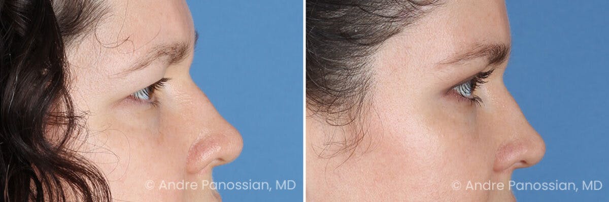 Eyelid Surgery (Blepharoplasty) Before & After Gallery - Patient 182379 - Image 3
