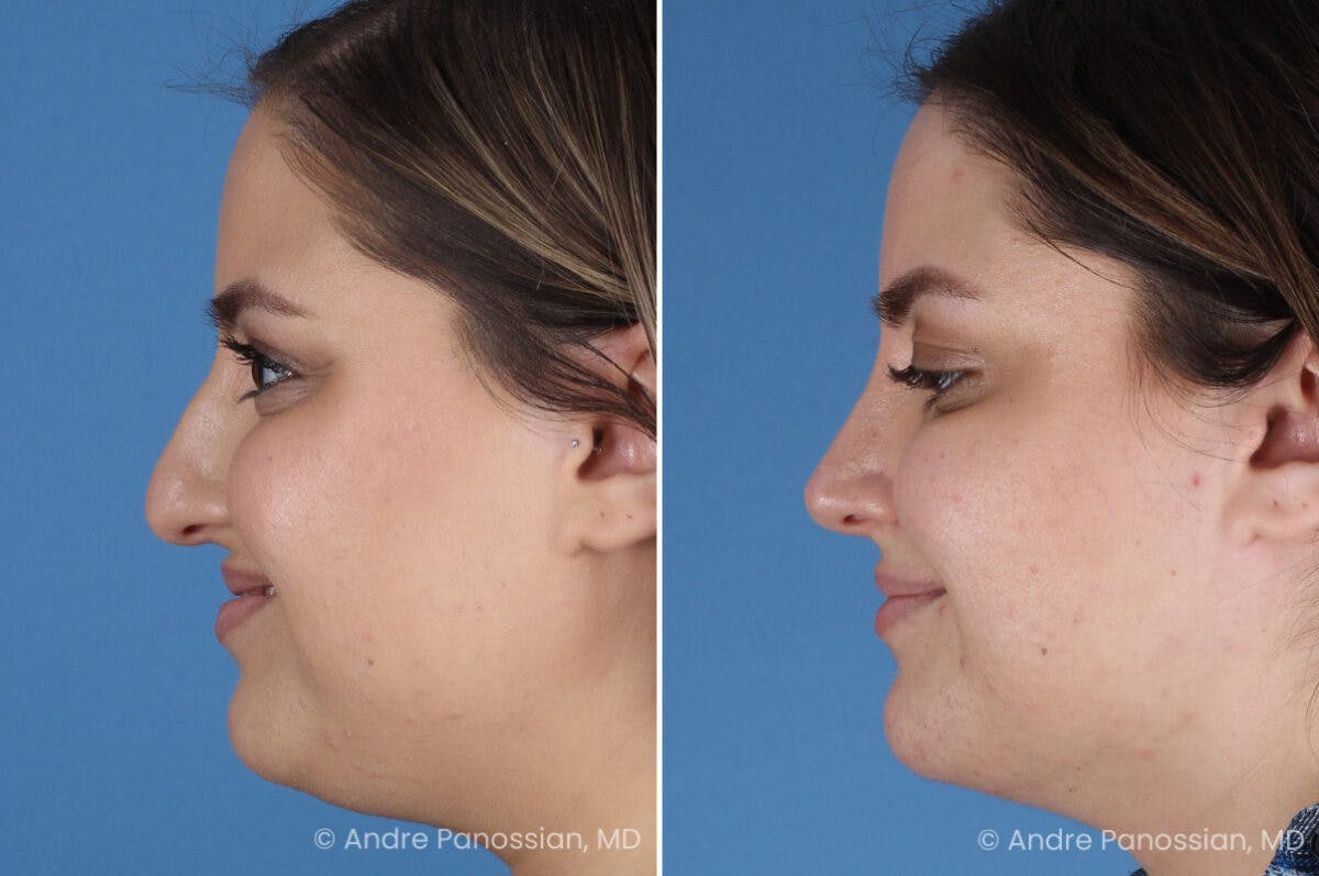 Rhinoplasty Before & After Gallery - Patient 153862 - Image 7