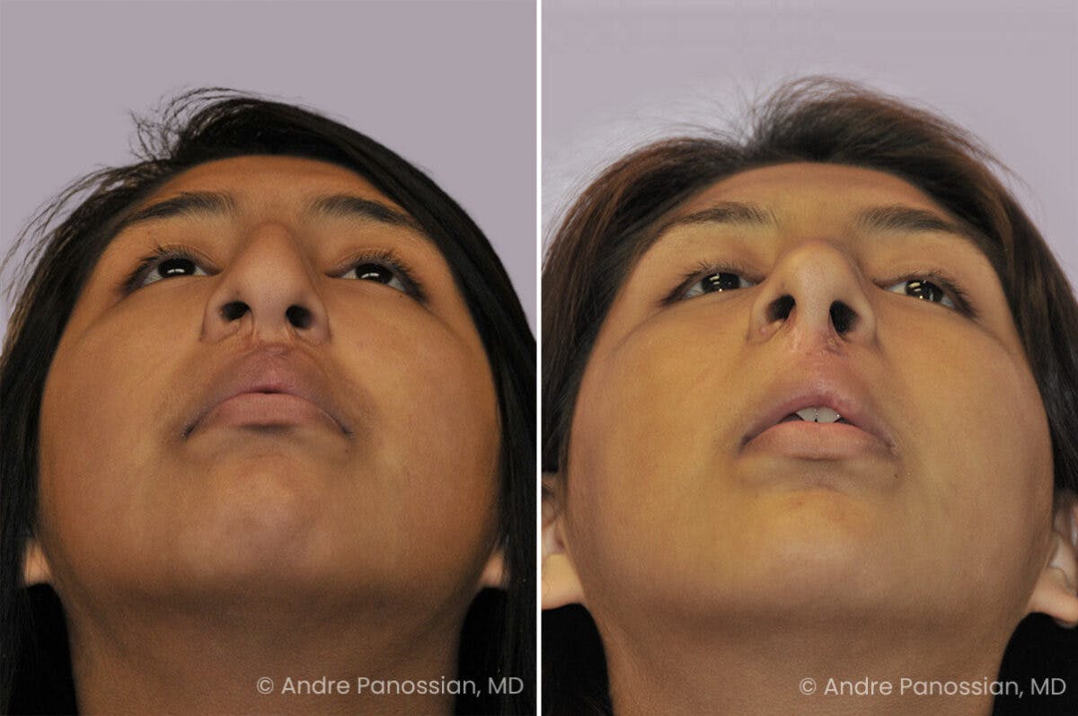 Cleft Lip Rhinoplasty Before & After Gallery - Patient 355708 - Image 4