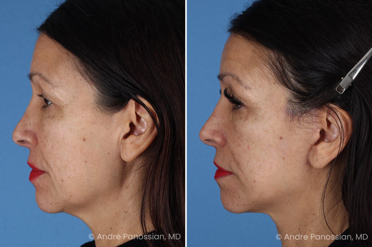 Facelift & Neck Lift Before & After Gallery - Patient 259086 - Image 5