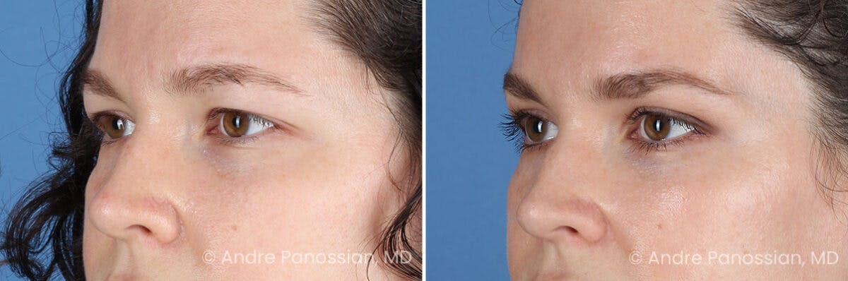 Eyelid Surgery (Blepharoplasty) Before & After Gallery - Patient 182379 - Image 4