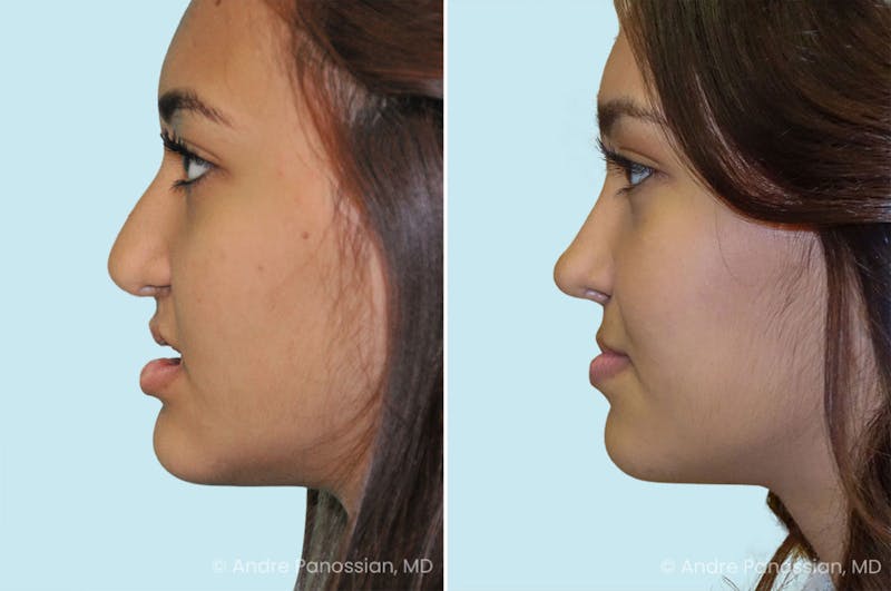 Revision Rhinoplasty Before & After Gallery - Patient 190303 - Image 1