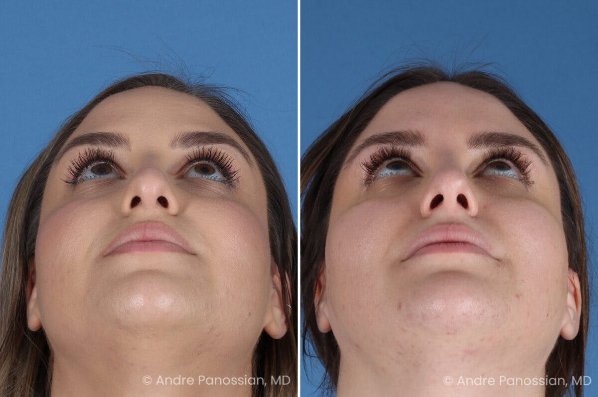 Rhinoplasty Before & After Gallery - Patient 153862 - Image 8