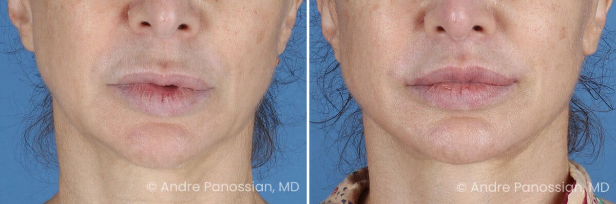 Lip Lift Before & After Gallery - Patient 102988 - Image 1