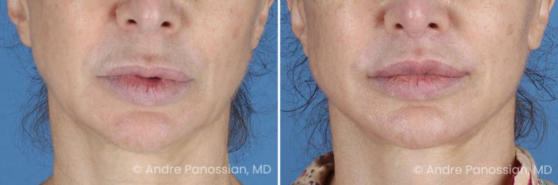 Lip Lift Before & After Gallery - Patient 102988 - Image 1