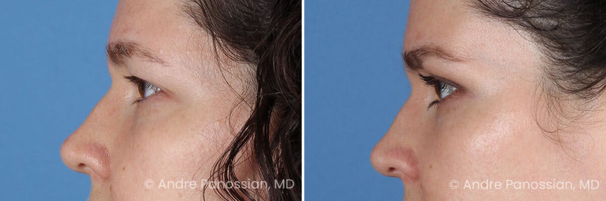 Eyelid Surgery (Blepharoplasty) Before & After Gallery - Patient 182379 - Image 5
