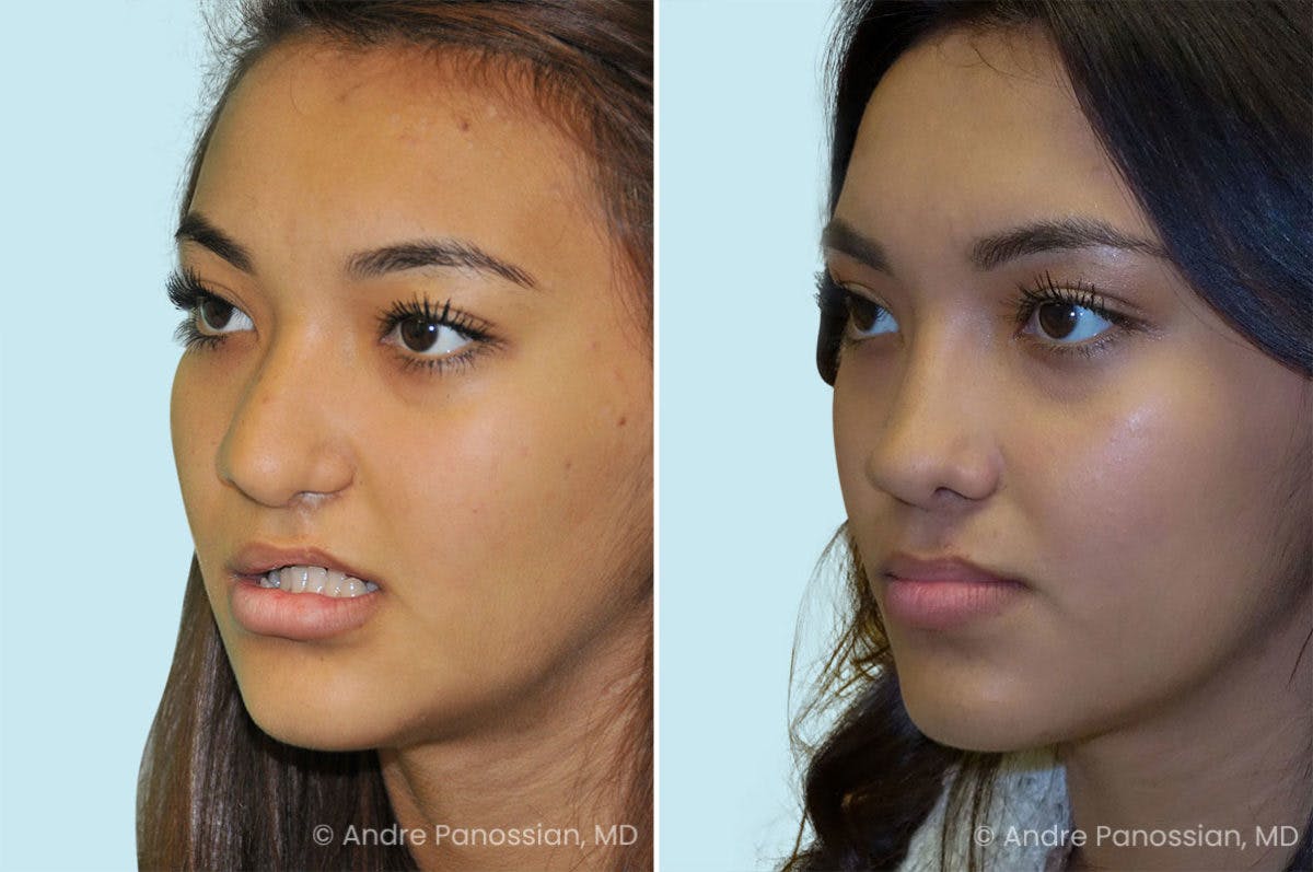 Revision Rhinoplasty Before & After Gallery - Patient 190303 - Image 3