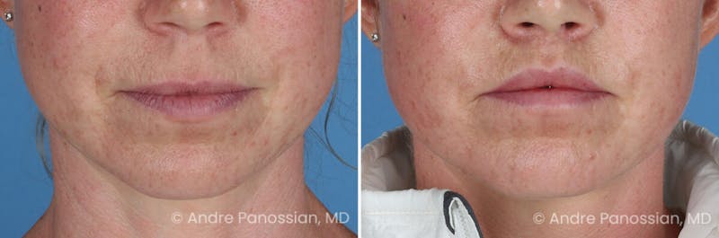 Lip Lift Before & After Gallery - Patient 528622 - Image 1