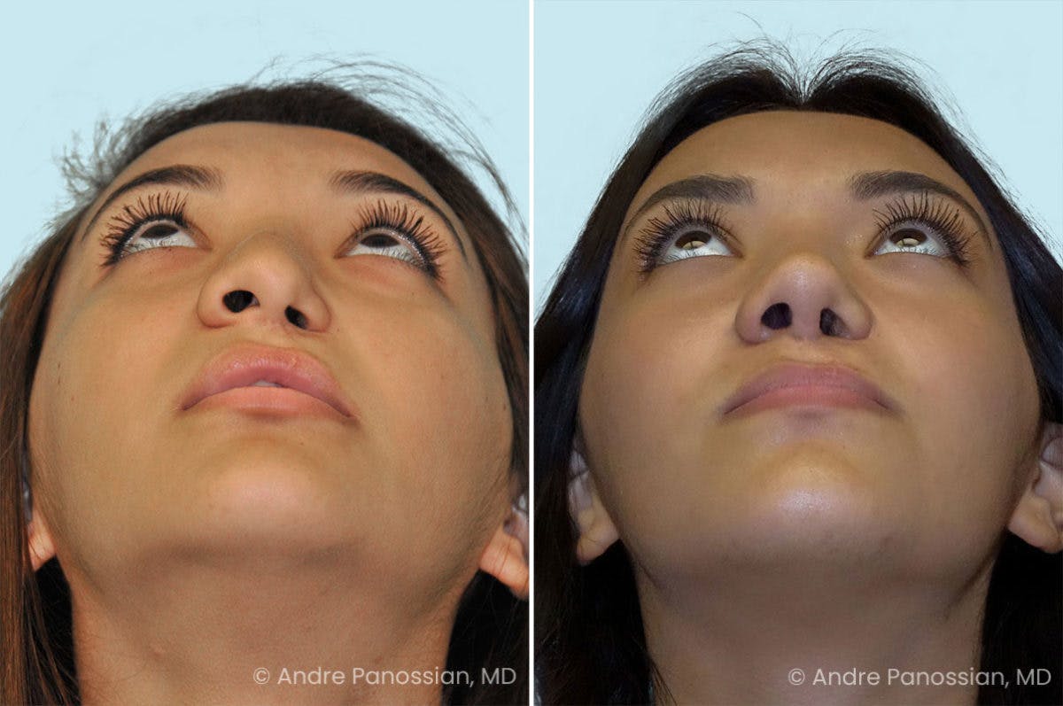 Revision Rhinoplasty Before & After Gallery - Patient 190303 - Image 4