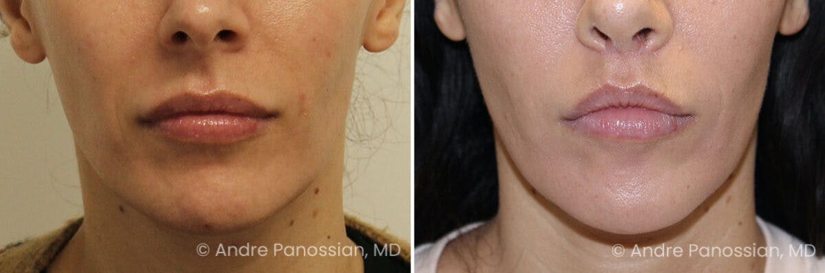 Lip Lift Before & After Gallery - Patient 341518 - Image 1