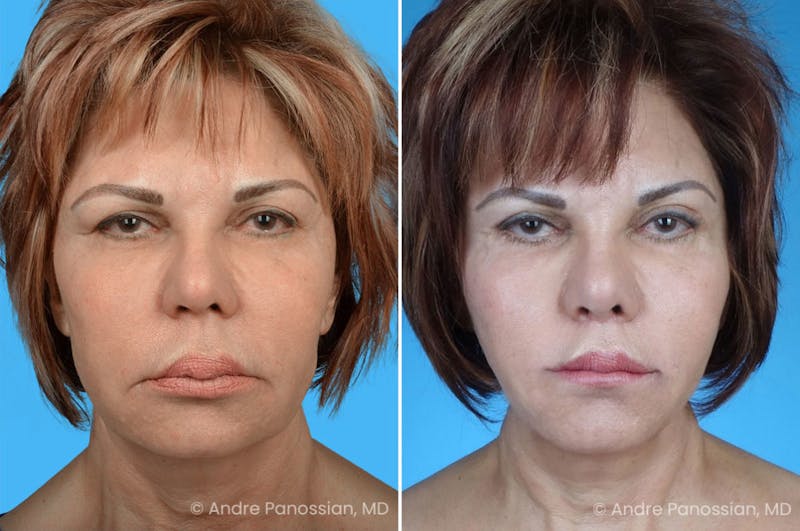Facelift & Neck Lift Before & After Gallery - Patient 223275 - Image 1