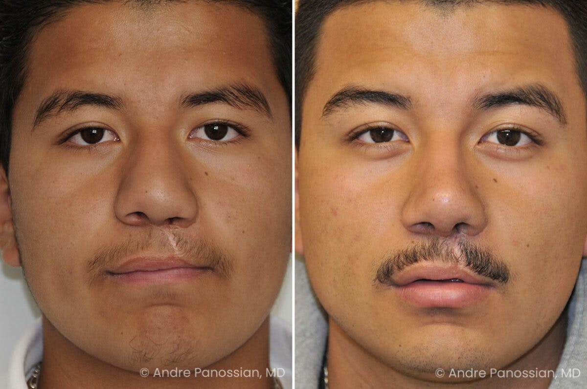Cleft Lip Rhinoplasty Before & After Gallery - Patient 300800 - Image 2