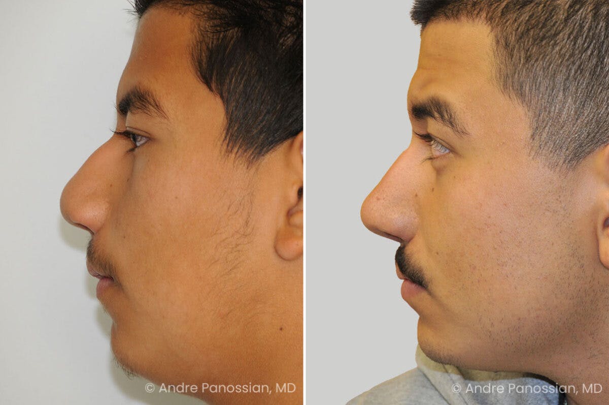 Cleft Lip Rhinoplasty Before & After Gallery - Patient 300800 - Image 1