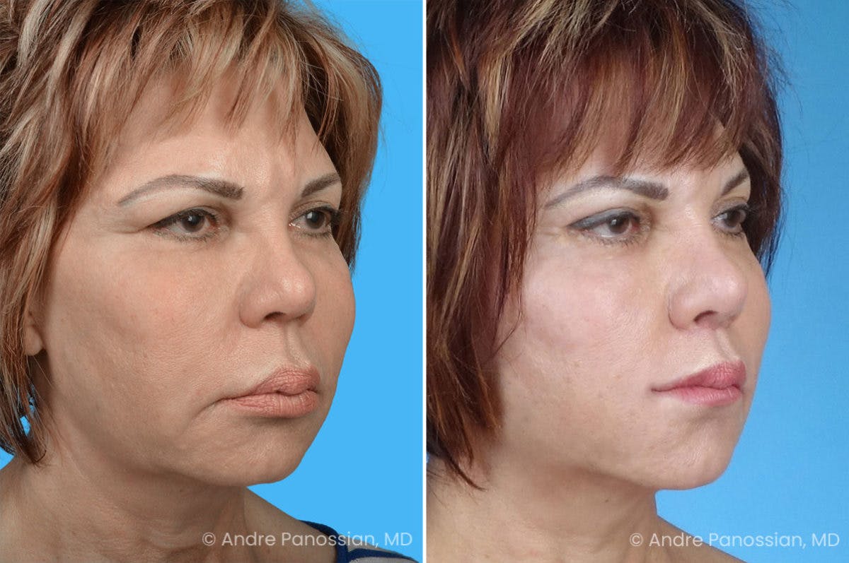 Facelift & Neck Lift Before & After Gallery - Patient 223275 - Image 2
