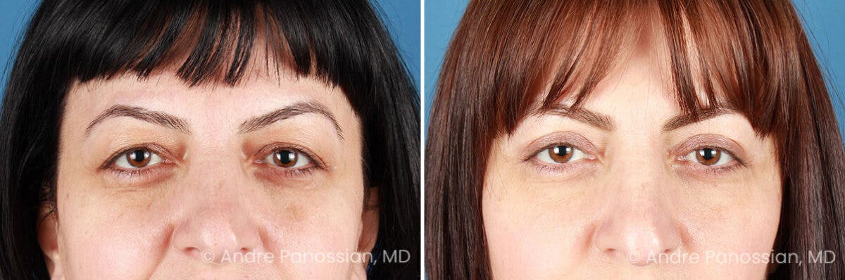 Eyelid Surgery (Blepharoplasty) Before & After Gallery - Patient 528050 - Image 1