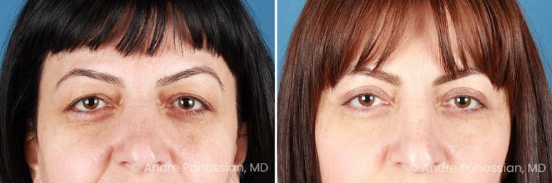 Eyelid Surgery (Blepharoplasty) Before & After Gallery - Patient 528050 - Image 1
