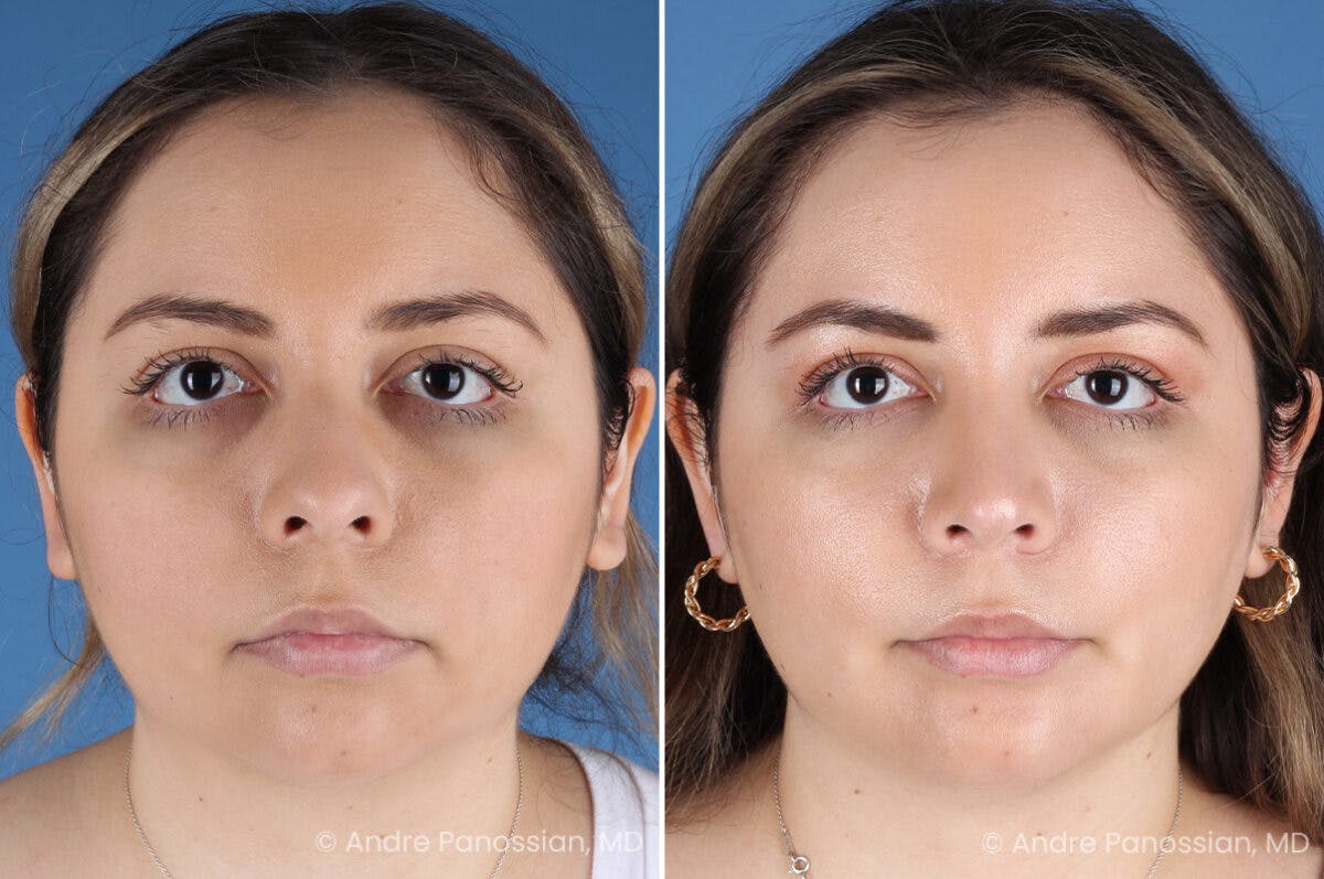 Rhinoplasty Before & After Gallery - Patient 186351 - Image 2