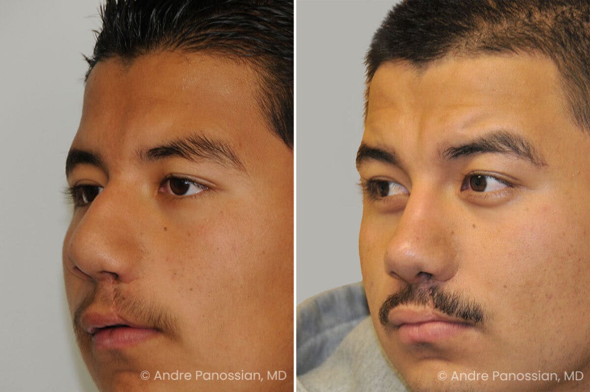Cleft Lip Rhinoplasty Before & After Gallery - Patient 300800 - Image 3