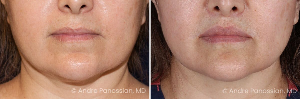 Lip Lift Before & After Gallery - Patient 170406 - Image 1