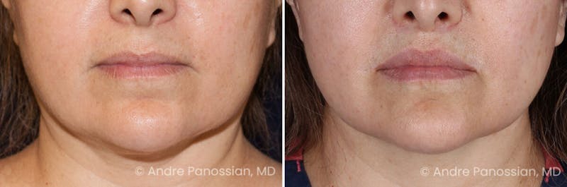 Lip Lift Before & After Gallery - Patient 170406 - Image 1