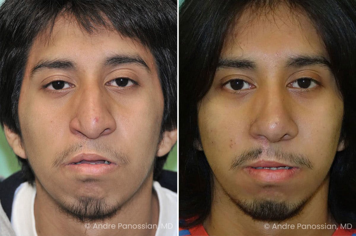 Revision Rhinoplasty Before & After Gallery - Patient 267728 - Image 2