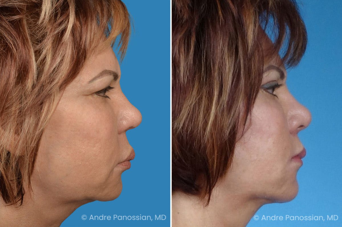 Facelift & Neck Lift Before & After Gallery - Patient 223275 - Image 3