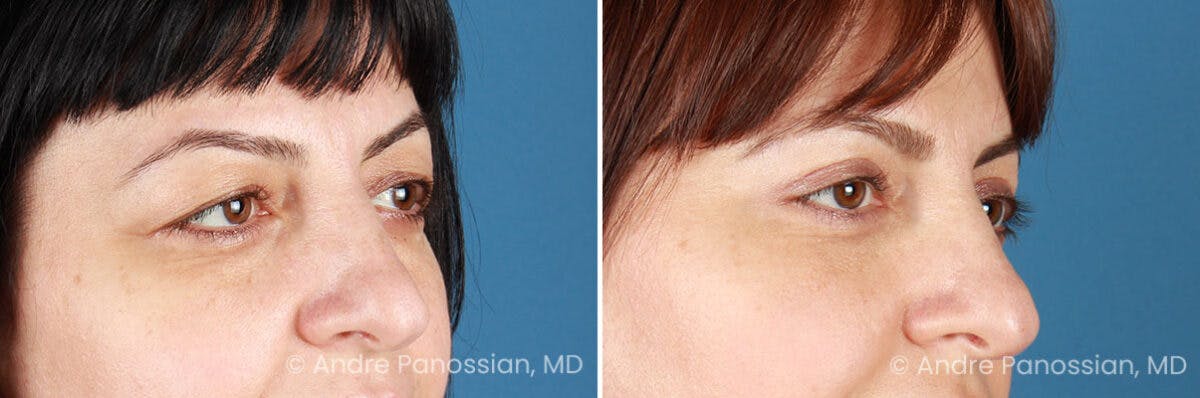 Eyelid Surgery (Blepharoplasty) Before & After Gallery - Patient 528050 - Image 2