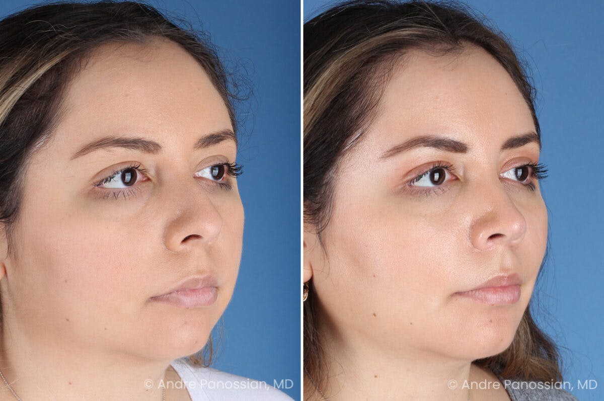 Rhinoplasty Before & After Gallery - Patient 186351 - Image 3