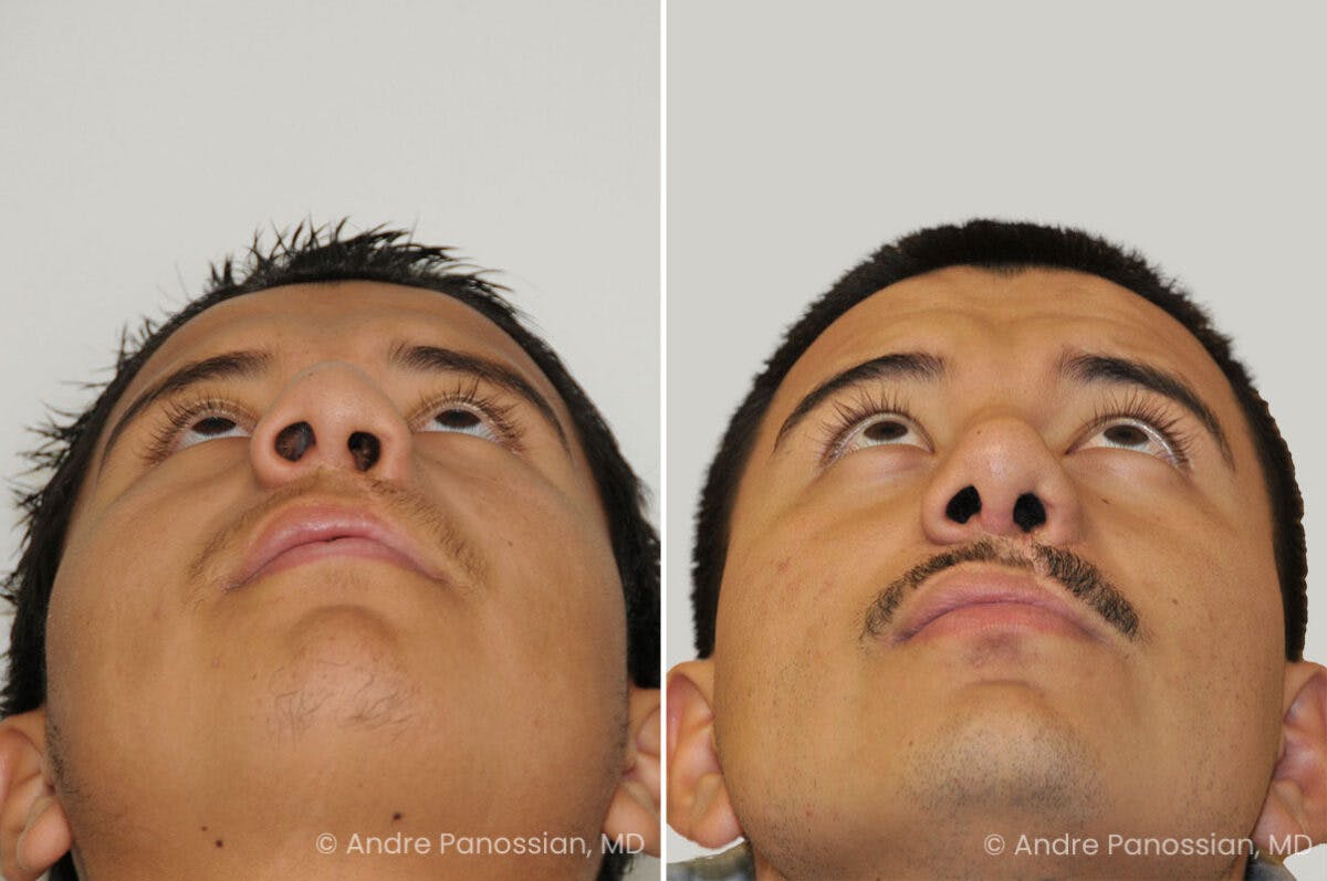 Cleft Lip Rhinoplasty Before & After Gallery - Patient 300800 - Image 4
