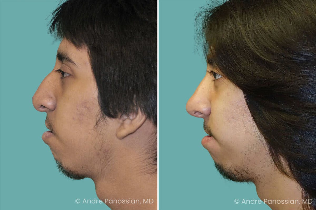 Revision Rhinoplasty Before & After Gallery - Patient 267728 - Image 1