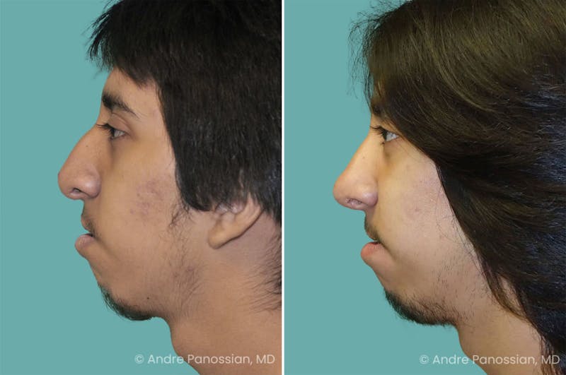 Revision Rhinoplasty Before & After Gallery - Patient 267728 - Image 1