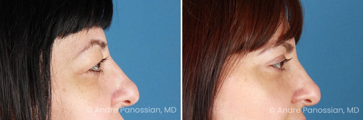 Eyelid Surgery (Blepharoplasty) Before & After Gallery - Patient 528050 - Image 3