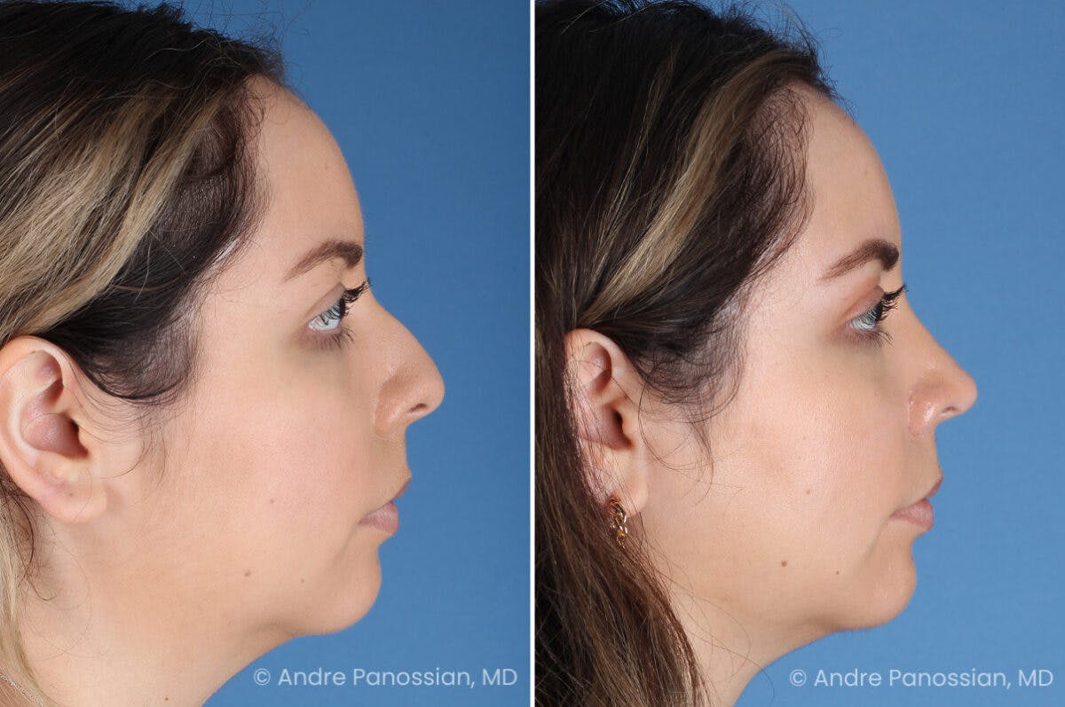 Rhinoplasty Before & After Gallery - Patient 186351 - Image 1