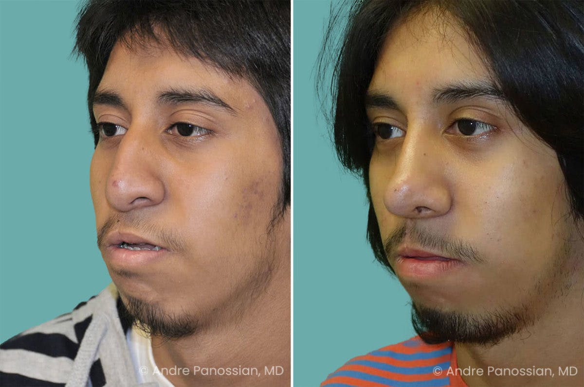 Revision Rhinoplasty Before & After Gallery - Patient 267728 - Image 3