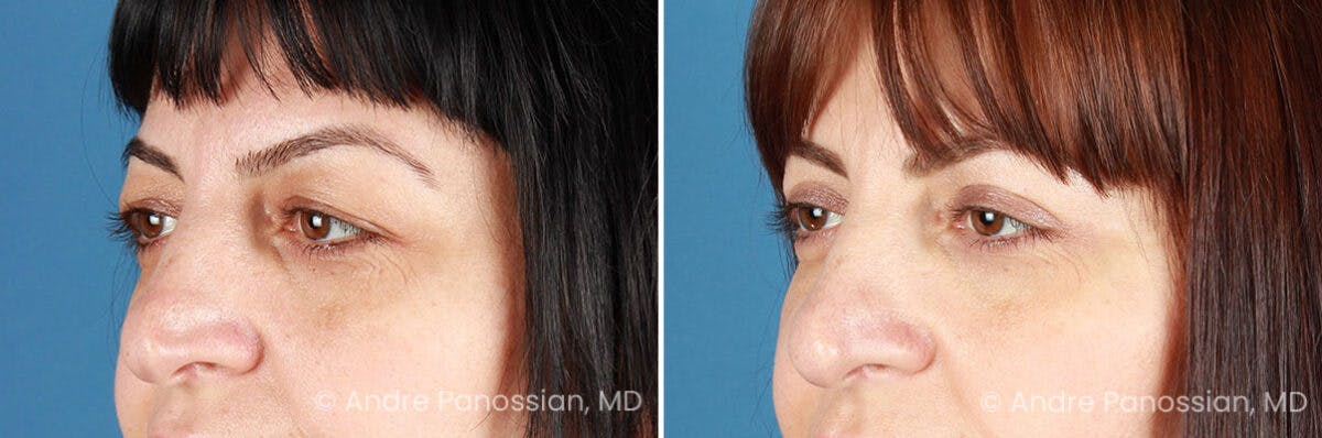 Eyelid Surgery (Blepharoplasty) Before & After Gallery - Patient 528050 - Image 4
