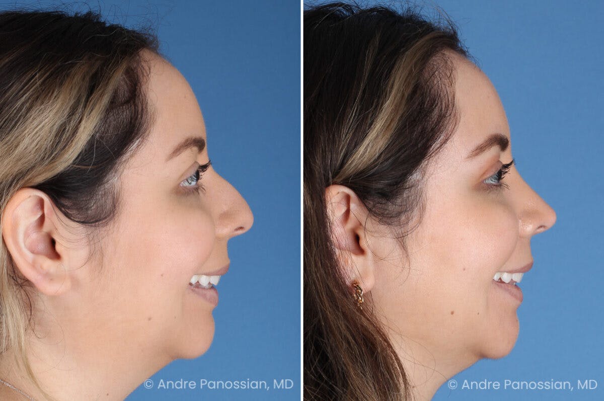 Rhinoplasty Before & After Gallery - Patient 186351 - Image 4