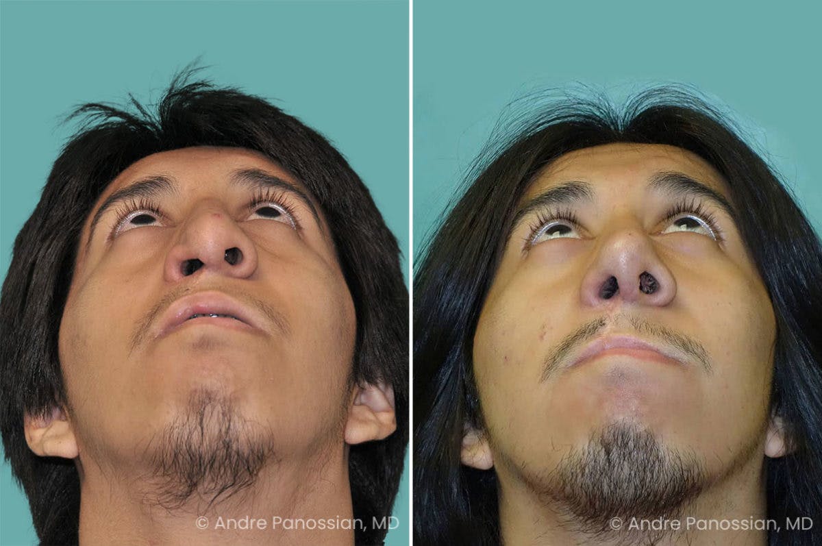 Revision Rhinoplasty Before & After Gallery - Patient 267728 - Image 4