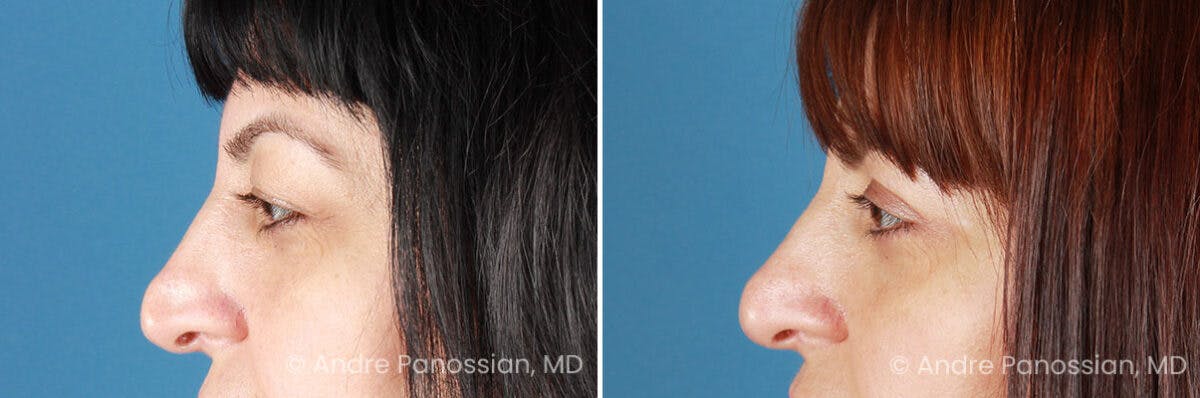Eyelid Surgery (Blepharoplasty) Before & After Gallery - Patient 528050 - Image 5