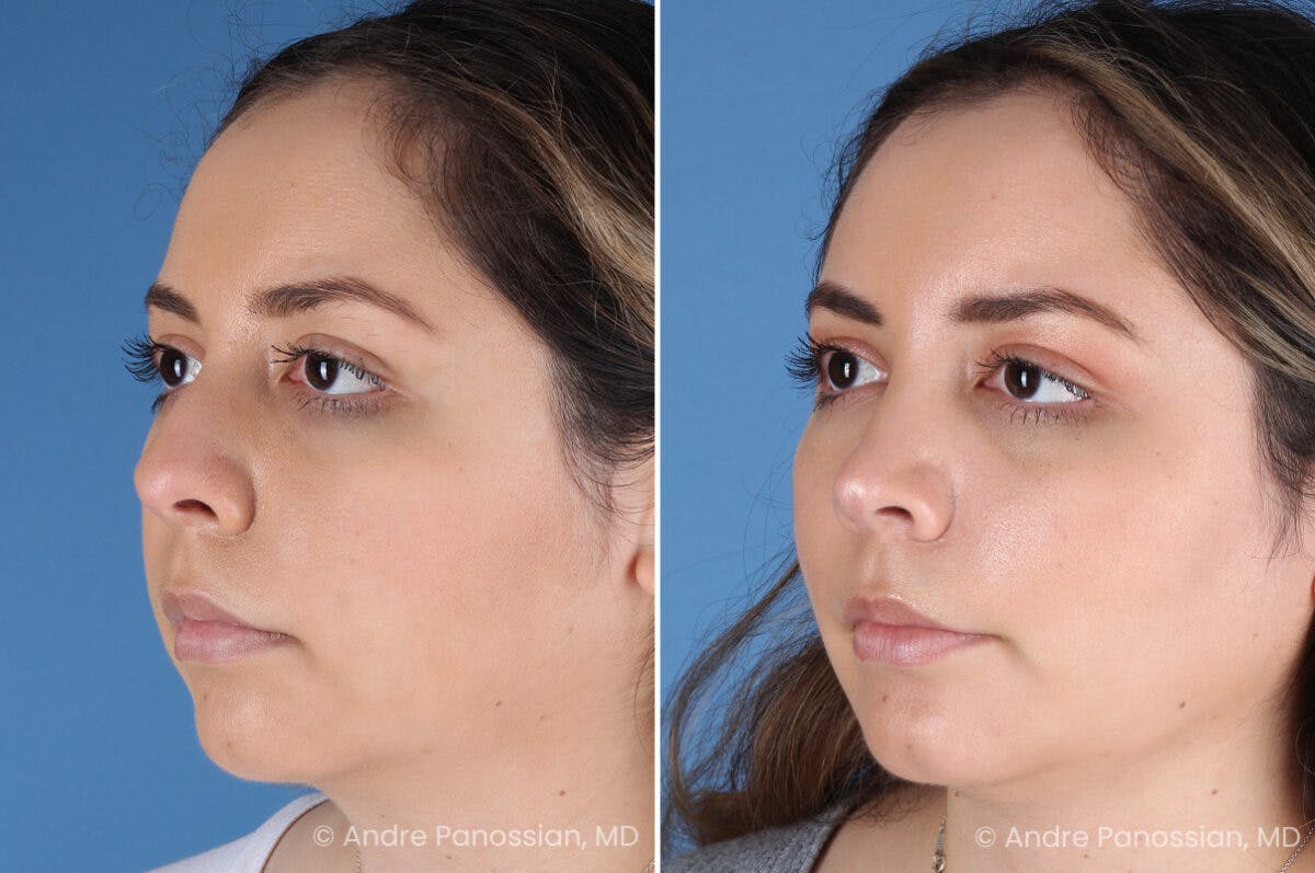Rhinoplasty Before & After Gallery - Patient 186351 - Image 5