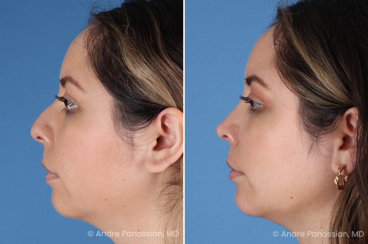 Rhinoplasty Before & After Gallery - Patient 186351 - Image 6