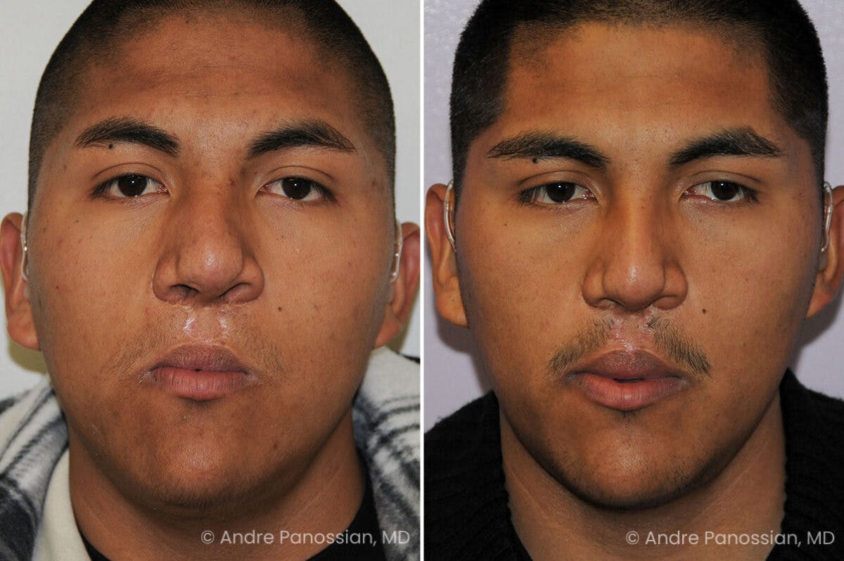 Cleft Lip Rhinoplasty Before & After Gallery - Patient 163337 - Image 2