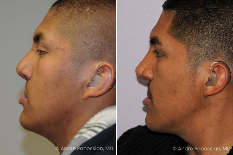 Cleft Lip Rhinoplasty Before & After Gallery - Patient 163337 - Image 1