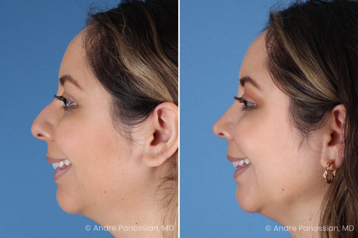 Rhinoplasty Before & After Gallery - Patient 186351 - Image 7
