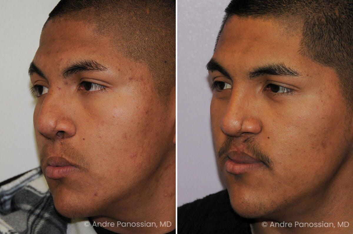 Cleft Lip Rhinoplasty Before & After Gallery - Patient 163337 - Image 3