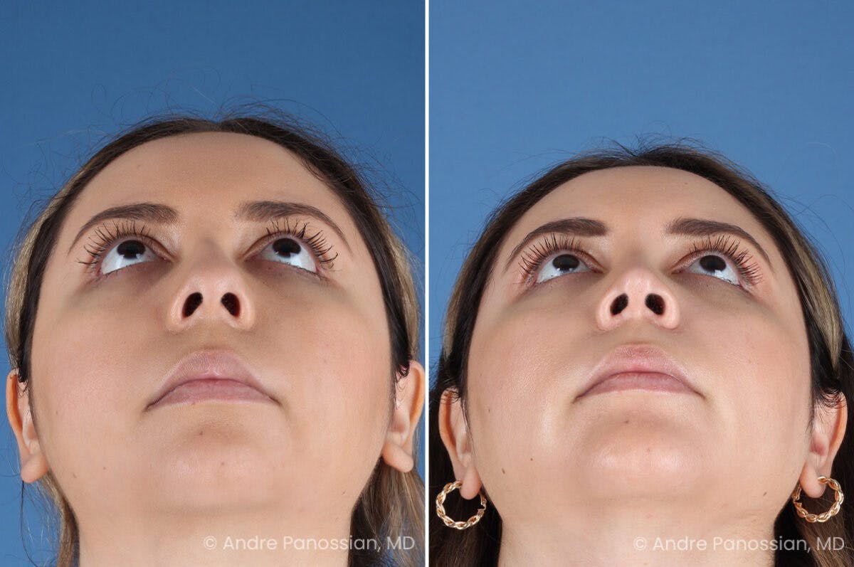 Rhinoplasty Before & After Gallery - Patient 186351 - Image 8