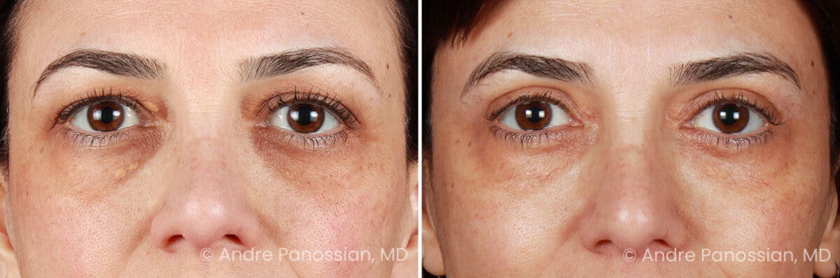 Eyelid Surgery (Blepharoplasty) Before & After Gallery - Patient 225746 - Image 1